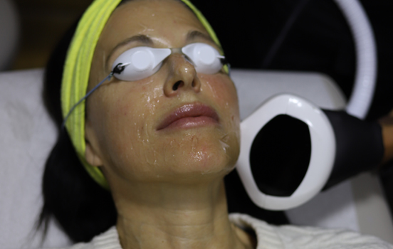 INMODE IPL (INTENSE PULSED LIGHT)