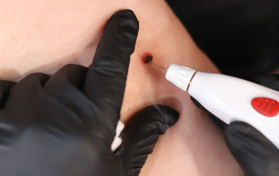 NON-SURGICAL SKIN CORRECTIONS