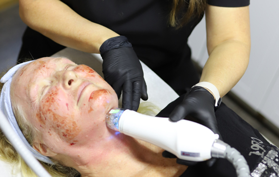 SECRET PRO RF MICRONEEDLING