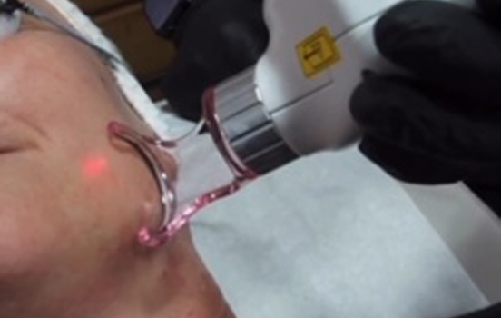 SECRETPRO CO2 LASER RESURFACING